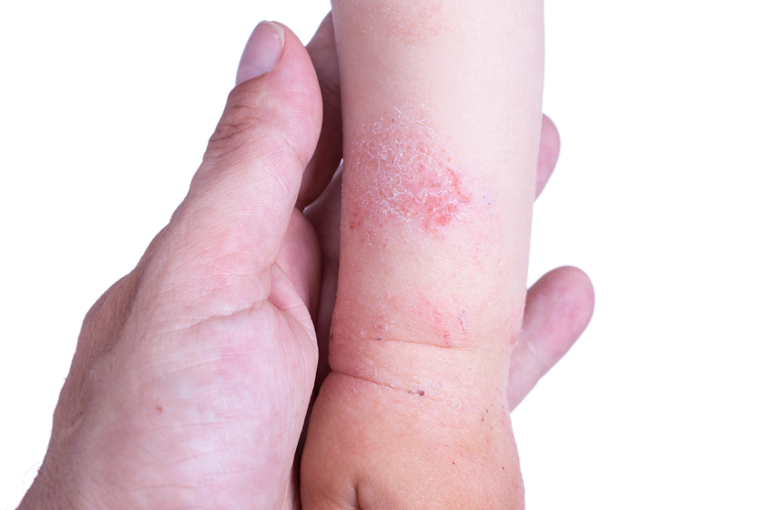 the-childrens-allergy-eczema